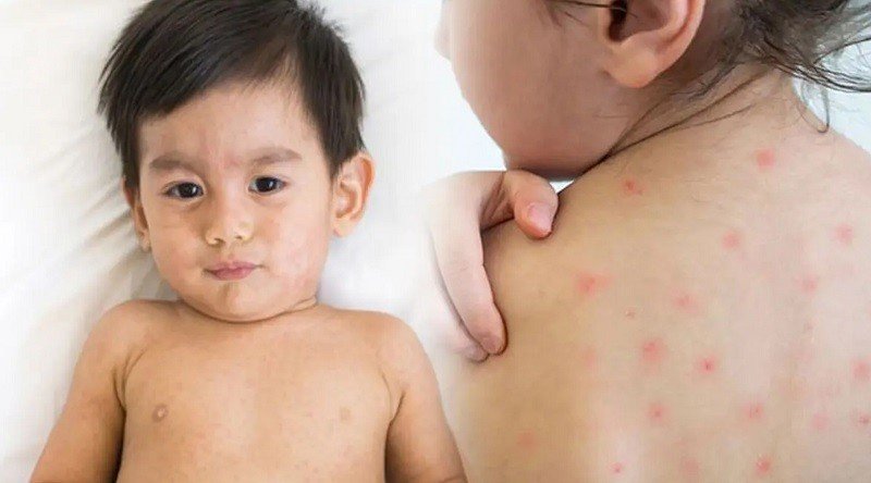 11 More Children Die from Measles and Related Symptoms